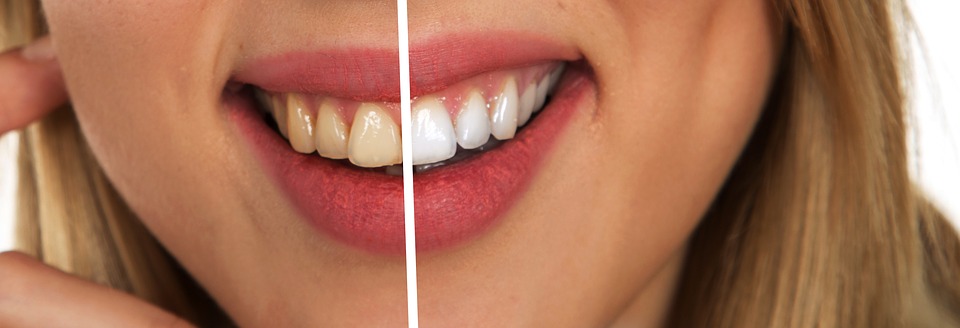 tooth-2414909_960_720