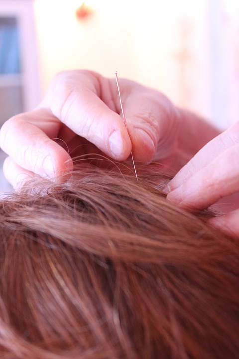 acupuncture-656578_960_720
