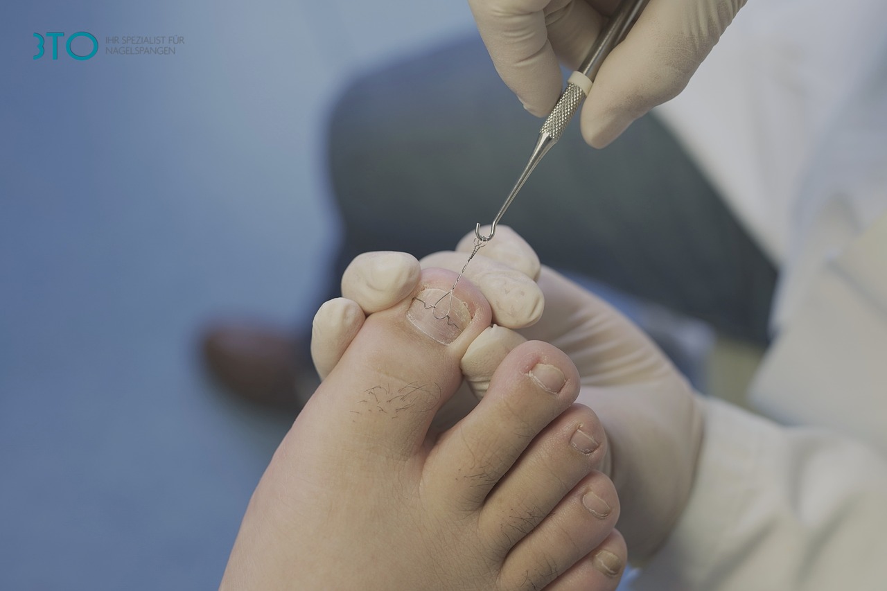 ingrown-toenail-6157931_1280